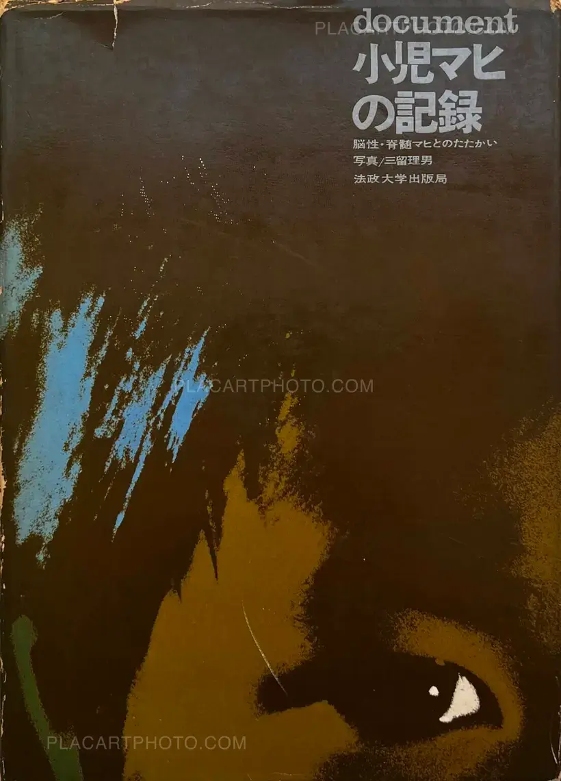 Tadao Mitome – Document : Shonimahi no kiroku / Document : Record of Infantile paralysis