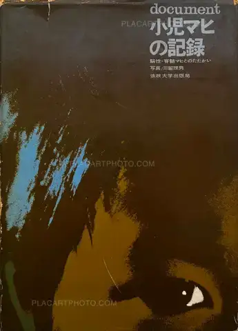 Tadao Mitome – Document : Shonimahi no kiroku / Document : Record of Infantile paralysis