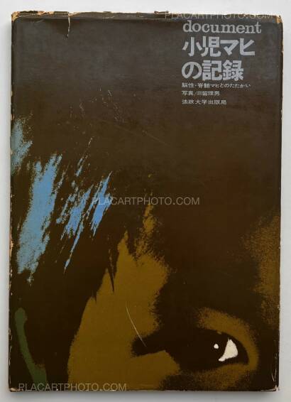 Tadao Mitome,Document : Shonimahi no kiroku / Document : Record of Infantile paralysis Tadao Mitome,Document : Shonimahi no kiroku / Document : Record of Infantile paralysis