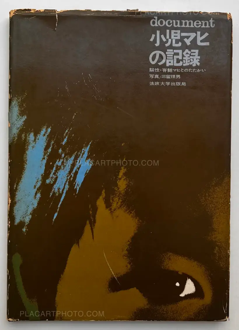 Tadao Mitome – Document : Shonimahi no kiroku / Document : Record of Infantile paralysis